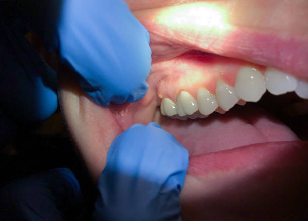 Best Emergency Dentist for Special Needs Patients in Lake Shore, WA